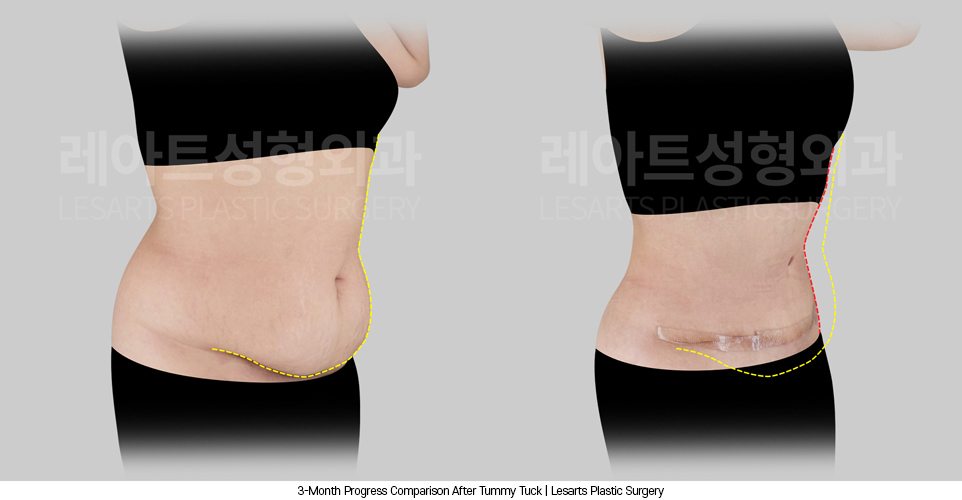 tummy_tuck_02_04_250408