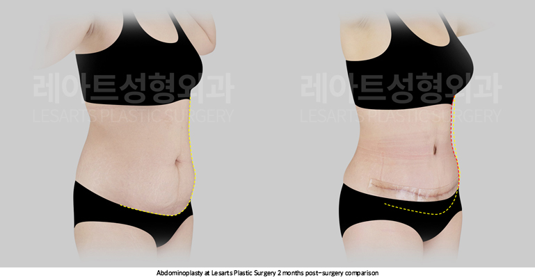 tummy_tuck_02_04_250414