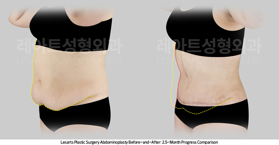 tummy_tuck_02_04_250421