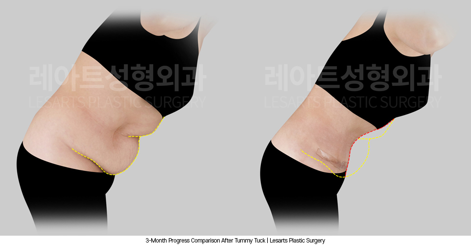 tummy_tuck_02_05_250408
