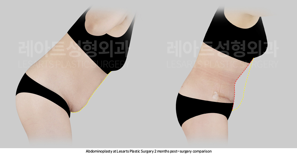 tummy_tuck_02_05_250414
