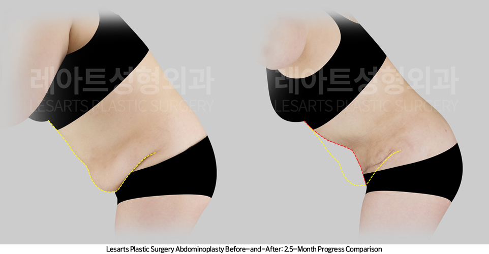 tummy_tuck_02_05_250421