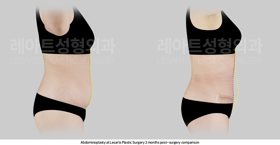 tummy_tuck_02_06_250414