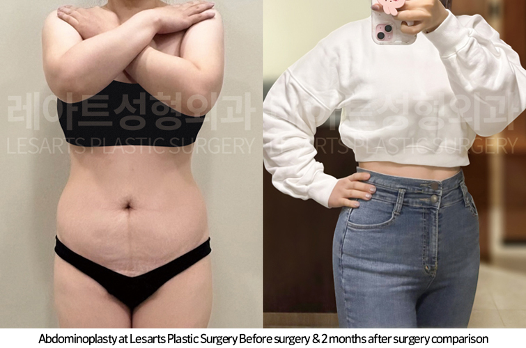 tummy_tuck_02_07_250414
