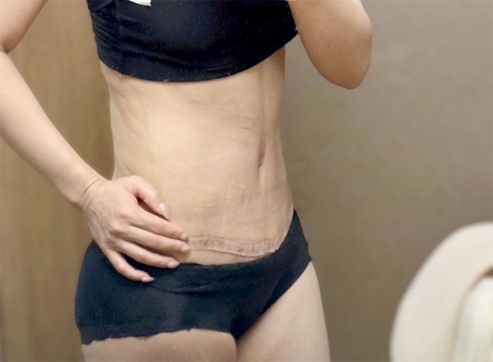 unni9T55lj after tummy tuck – flat stomach and stretch mark reduction at Lesarts Hospital Korea