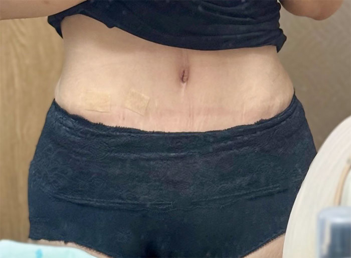 Close-up showing tummy tuck results after postpartum belly correction surgery in Seoul