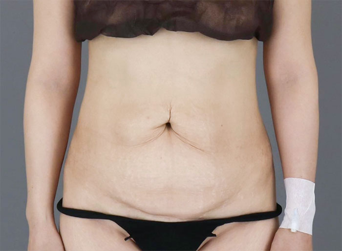 unni9T55lj before tummy tuck – loose belly skin after childbirth, Lesarts Plastic Surgery Korea