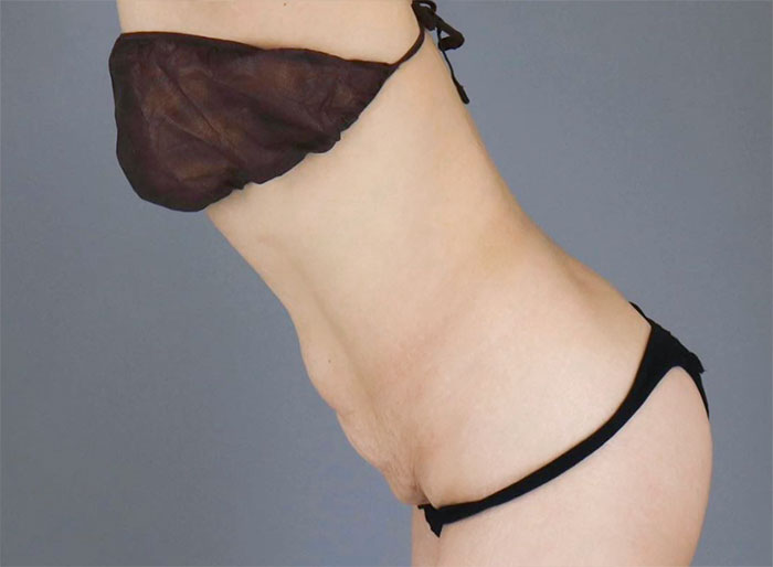 Side view showing sagging lower abdomen before surgery – best tummy tuck clinic in Gangnam