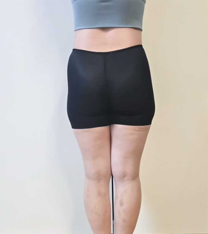 Back view before liposuction at Lesarts hospital in Seoul – visible fat on thighs and hips