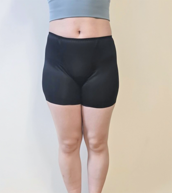 unniN293uz before thigh liposuction, saddlebag fat visible – Lesarts Plastic Surgery, Gangnam
