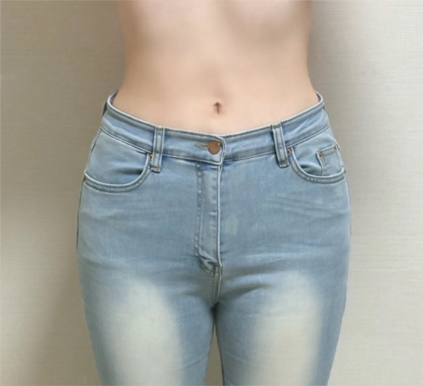 Haengbogi34 abdominal liposuction after surgery in Gangnam Korea – Lesarts Plastic Surgery