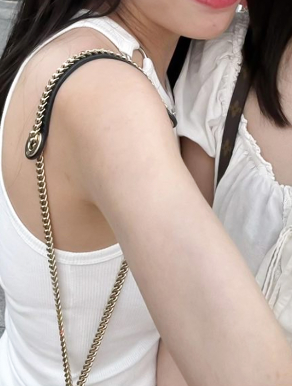 Kkulnyangnyang arm liposuction 9 months after surgery in Korea – Lesarts Plastic Surgery