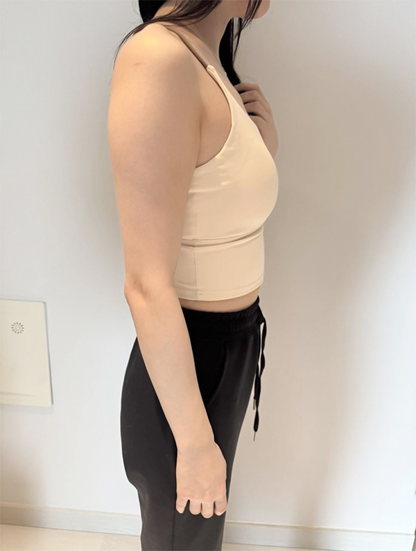 Kkulnyangnyang arm liposuction before photo in Korea – Lesarts Plastic Surgery Gangnam