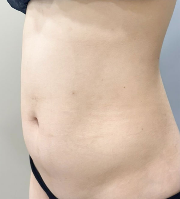 Loroppungppangyi belly fat and love handles before abdominal liposuction at best plastic surgery clinic in Gangnam