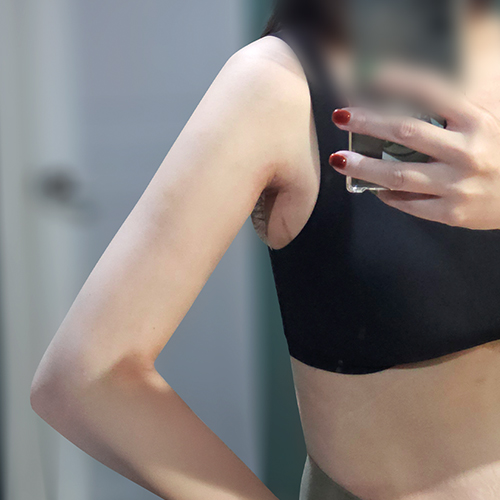 Mollaehanendaieteu arm liposuction and brachioplasty 1.5 months after surgery in Korea – Lesarts Plastic Surgery