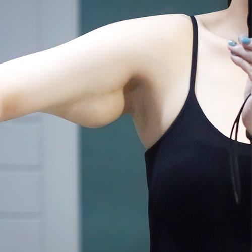 Mollaehanendaieteu arm liposuction and brachioplasty before photo in Korea – Lesarts Plastic Surgery
