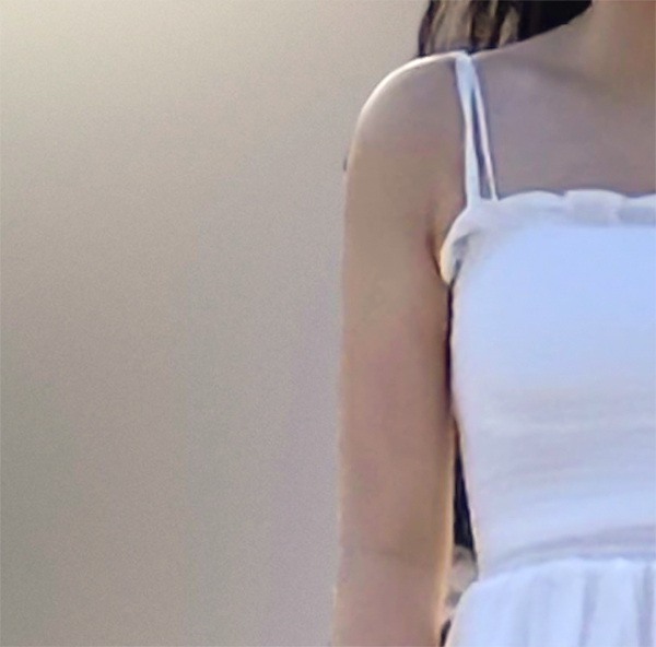 Nyeoeongha slim arms after arm liposuction recovery at best plastic surgery clinic in Gangnam
