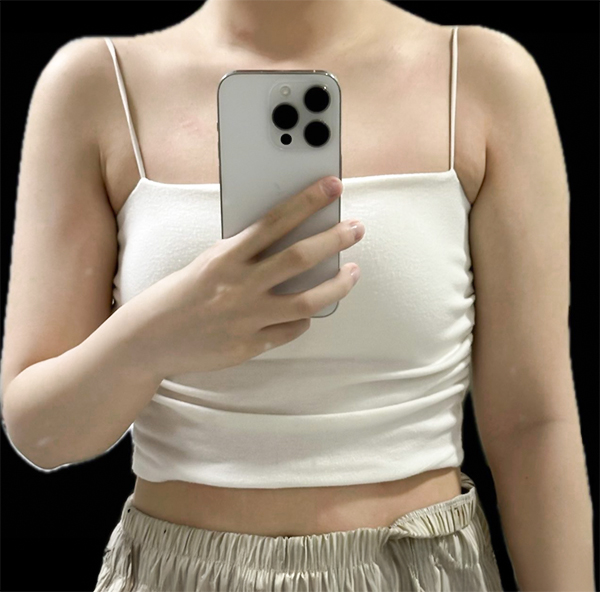 Nyeoeongha arm liposuction with accessory breast before photo in Korea – Lesarts Plastic Surgery