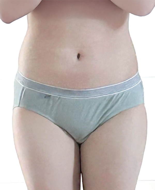 Yaruki love handle and thigh liposuction before photo in Korea – Lesarts Plastic Surgery