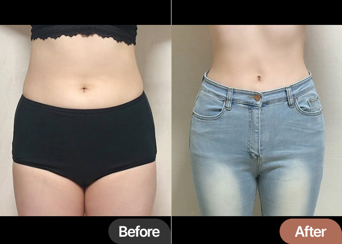 Haengbogi34 abdominal liposuction before & after in Korea – Best Plastic Surgery Clinic in Gangnam Lesarts