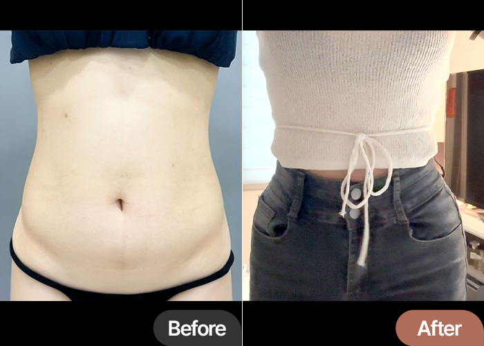 Loroppungppangyi abdominal liposuction before & after with love handles in Korea – Best Plastic Surgery Clinic in Gangnam Lesarts