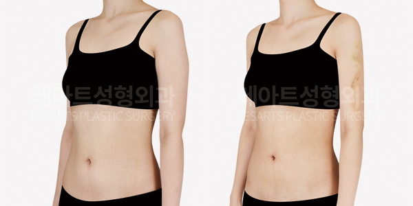abdominal_liposuction_01_thumbnail_250430