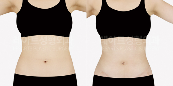 abdominal_liposuction_01_thumbnail_250520