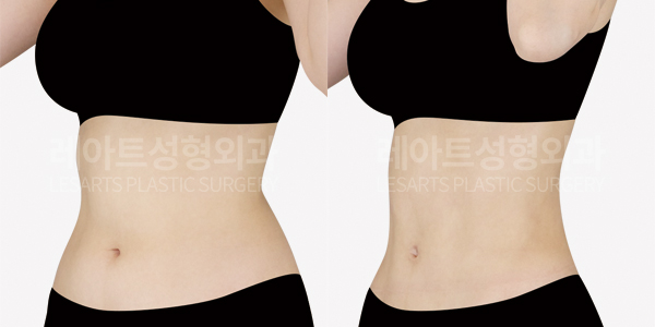 abdominal_liposuction_01_thumbnail_250529