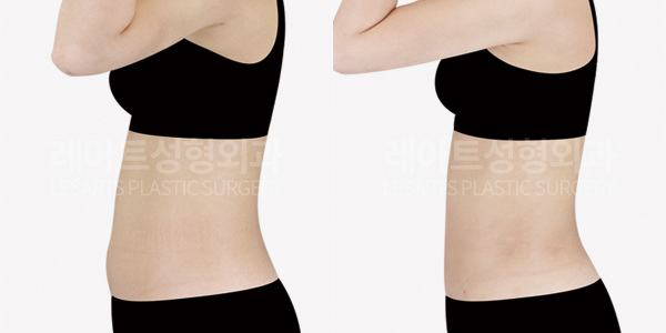 abdominal_liposuction_01_thumbnail_250617