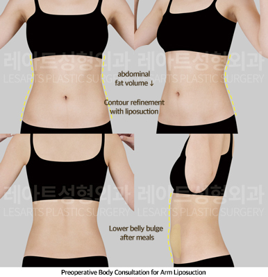 abdominal_liposuction_02_01_250430