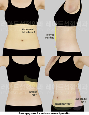 abdominal_liposuction_02_01_250520