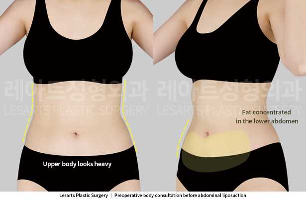abdominal_liposuction_02_01_250529