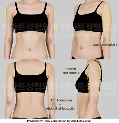 abdominal_liposuction_02_02_250430