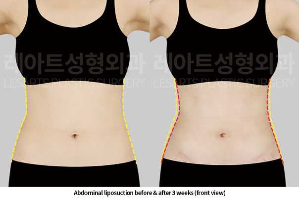 abdominal_liposuction_02_02_250520
