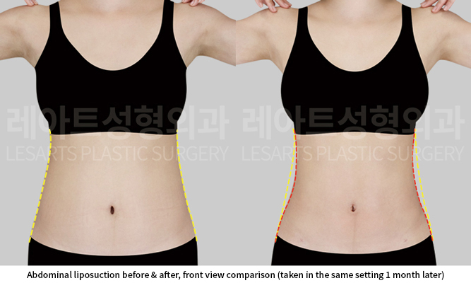 abdominal_liposuction_02_02_250617