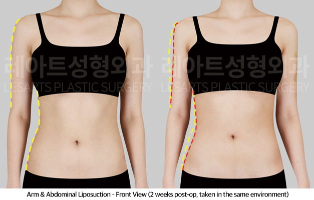 abdominal_liposuction_02_03_250430