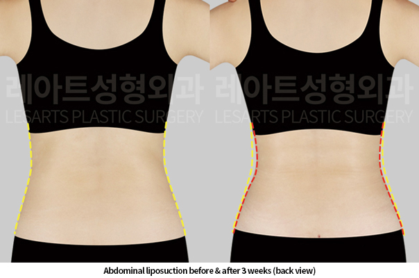 abdominal_liposuction_02_03_250520