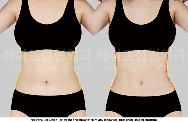 abdominal_liposuction_02_03_250529
