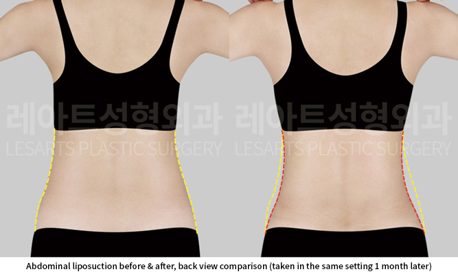 abdominal_liposuction_02_03_250617