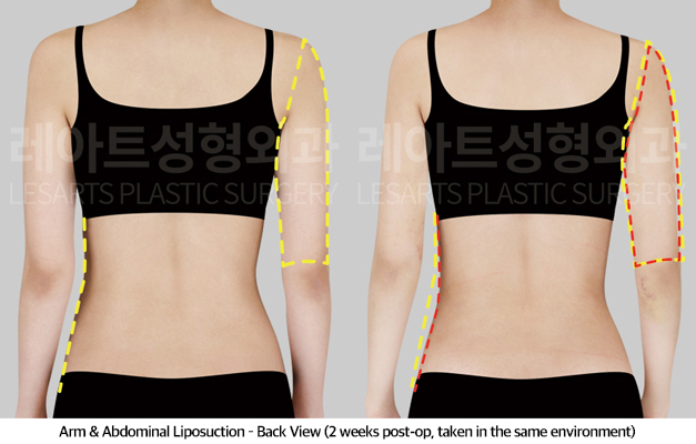 abdominal_liposuction_02_04_250430