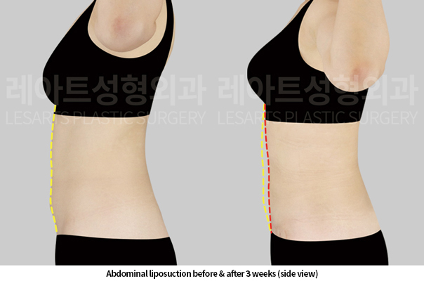 abdominal_liposuction_02_04_250520