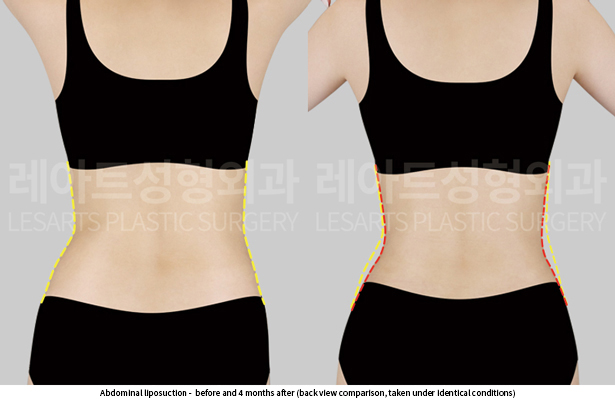 abdominal_liposuction_02_04_250529