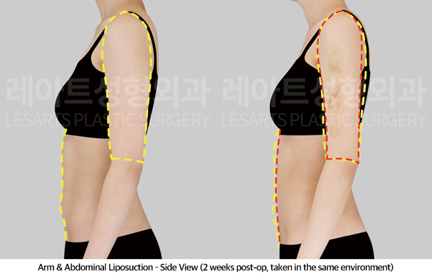 abdominal_liposuction_02_05_250430