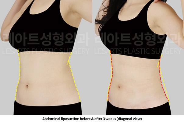 abdominal_liposuction_02_05_250520