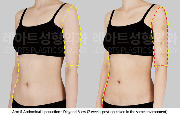 abdominal_liposuction_02_06_250430