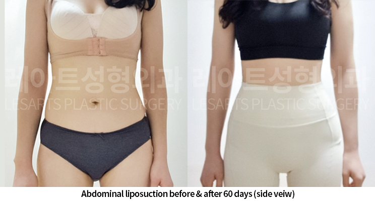 abdominal_liposuction_02_06_250520