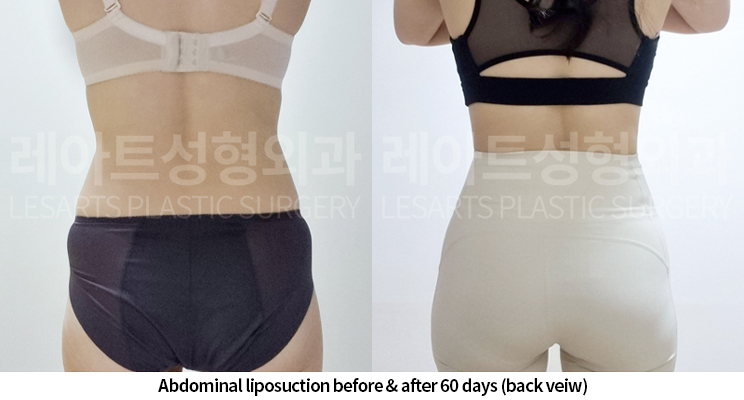 abdominal_liposuction_02_07_250520