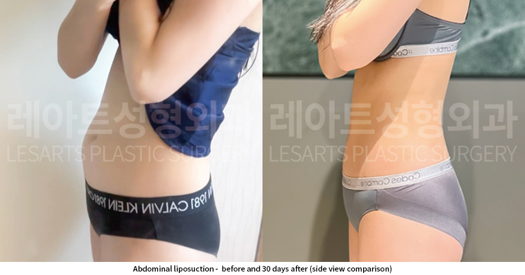 abdominal_liposuction_02_07_250529