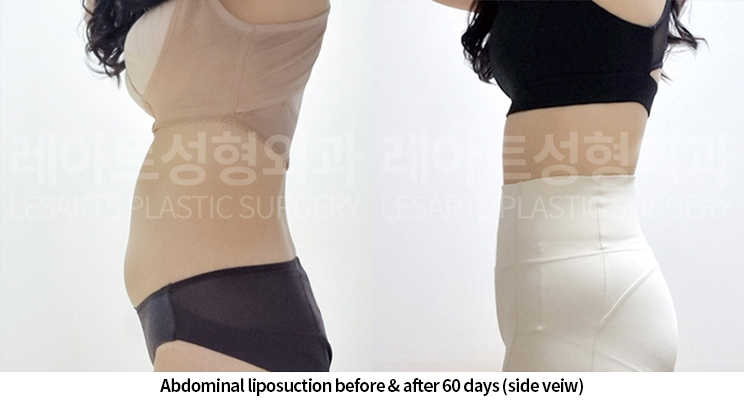 abdominal_liposuction_02_08_250520