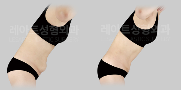 abdominoplasty_01_thumbnail_250507
